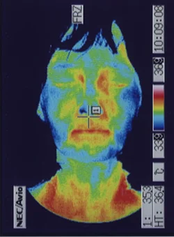 耳管狭窄症の患者様の治療後サーモグラフィ画像
