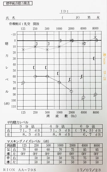 片耳の聴力が改善してきた子供の聴力図