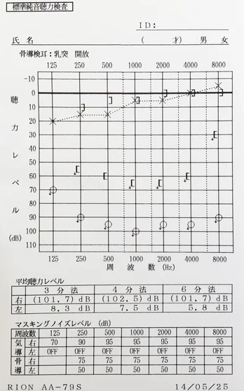 突発性難聴で片耳が聴こえない子供の聴力図
