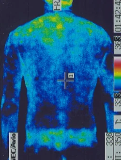 治療前のサーモグラフィ画像|自律神経が乱れて全身の体温が低下している状態の、突発性難聴後遺症の患者さん