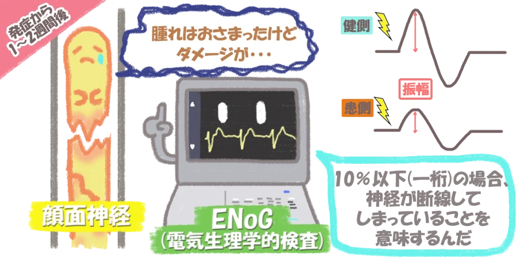 顔面神経麻痺の治療｜ステロイドが効かないと感じるのは神経の深いダメージのせい
